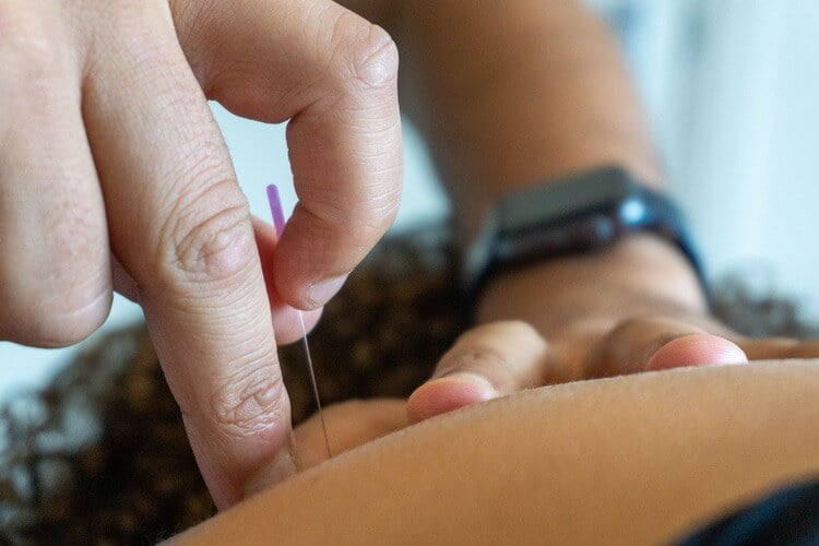 Behandeling Dry Needling